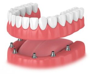 https://studiokalaj.it/wp-content/uploads/2022/09/all-on-6-dental-implan-300x246-1.jpg
